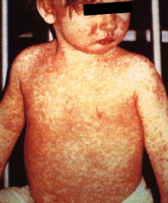 Measles Cases Reported In LaGrange and DeKalb Counties